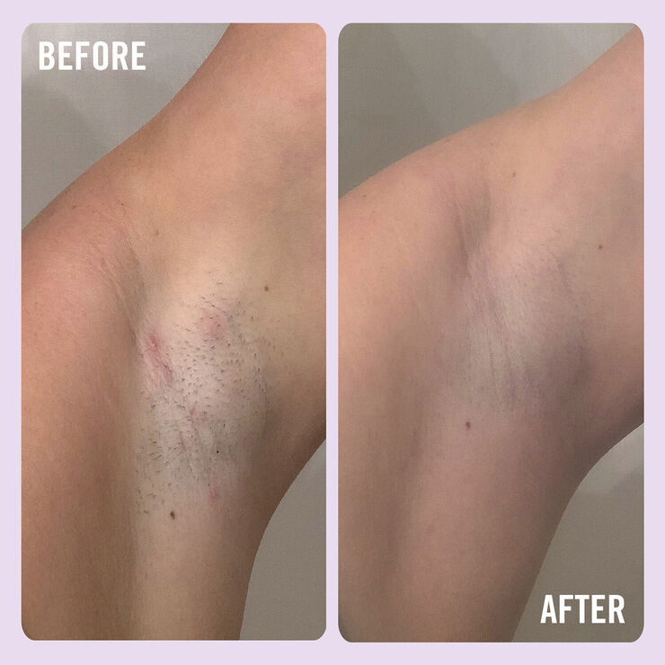 Ingrown Hair Pads with BHA & AHA