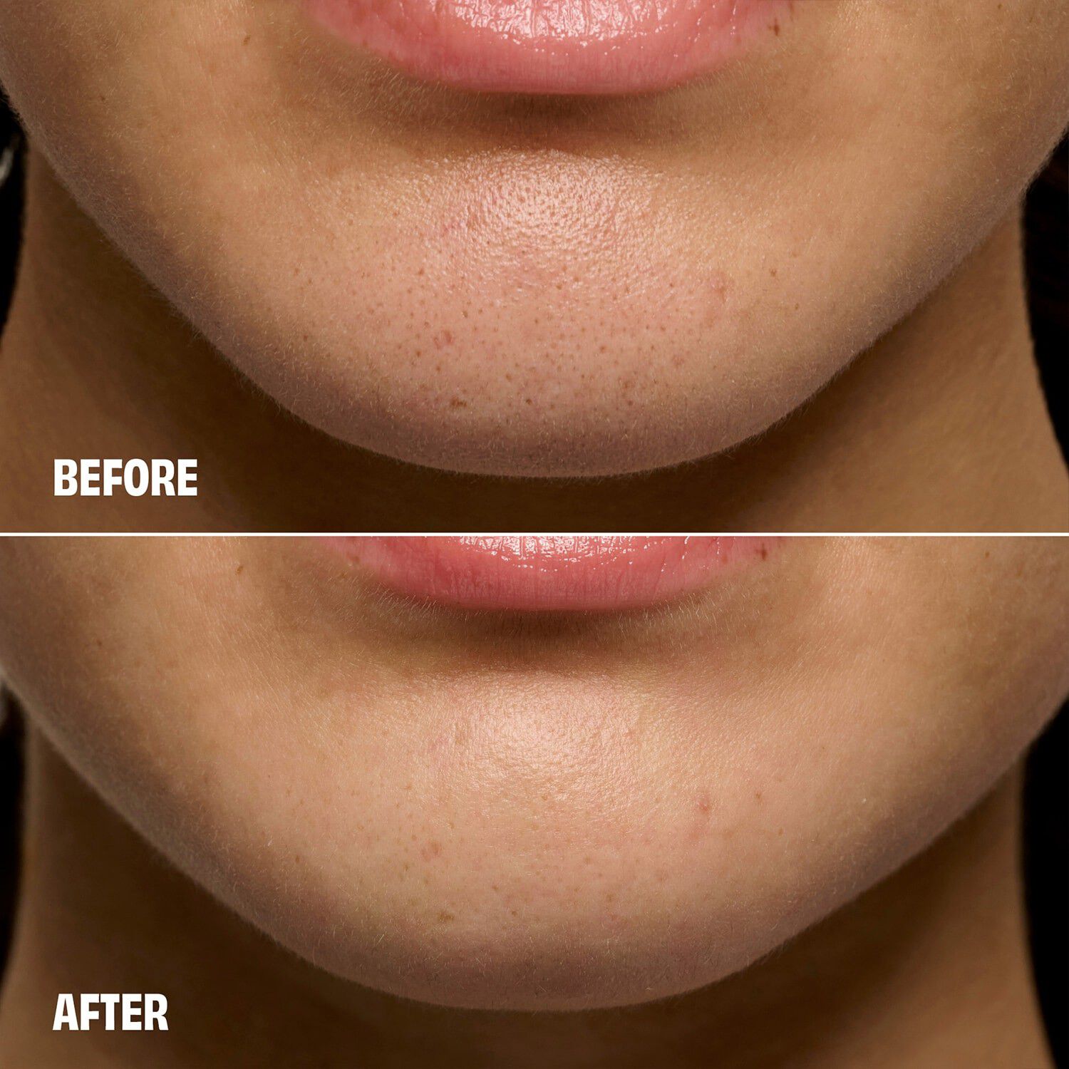 The POREfessional Degunker - v&aelig;rkt&oslash;j til tilstoppede porer