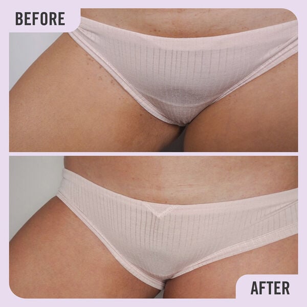 Ingrown Hair Pads with BHA & AHA