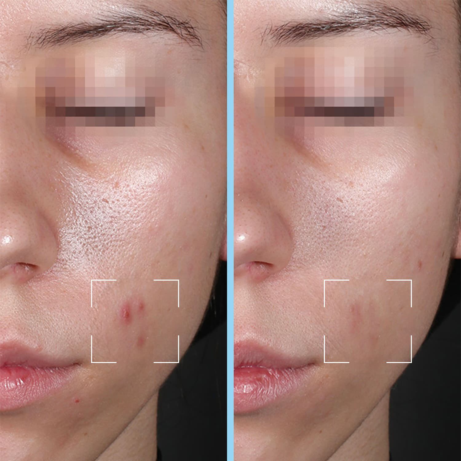 Purity kapsler - Serum mod urenheder beriget med salicylsyre og HA