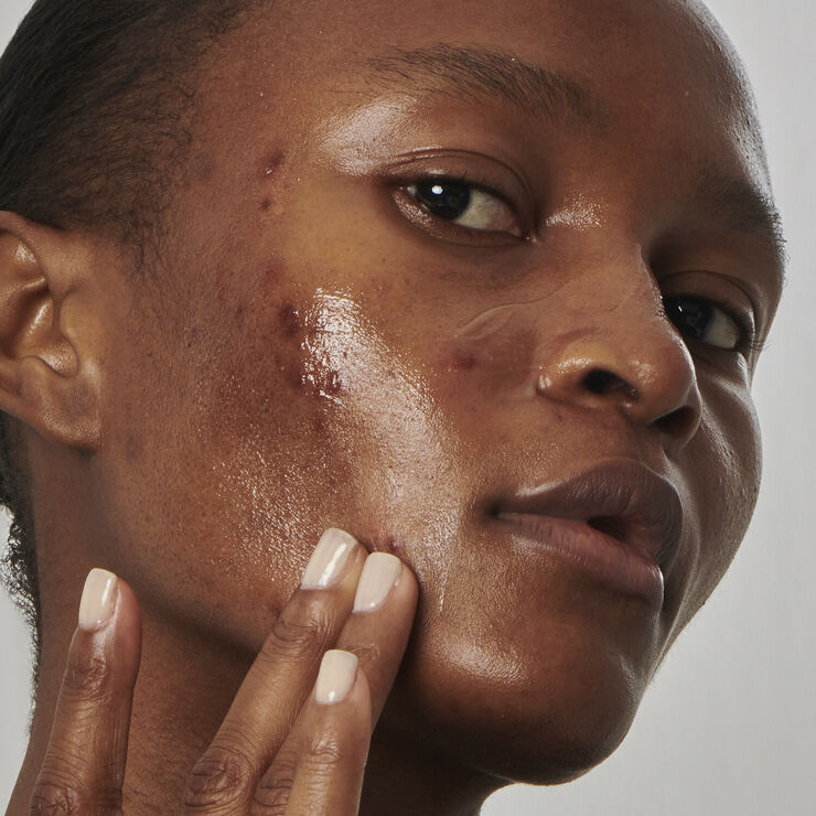 Excess oil solution with 20% niacinamide - Face serum