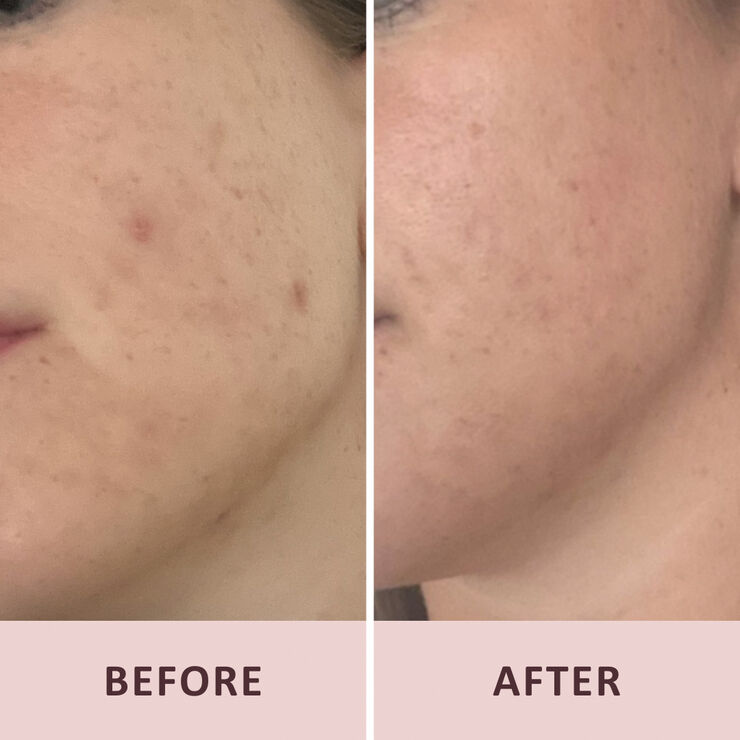 Pudderdåserne Azelainsyre 10%