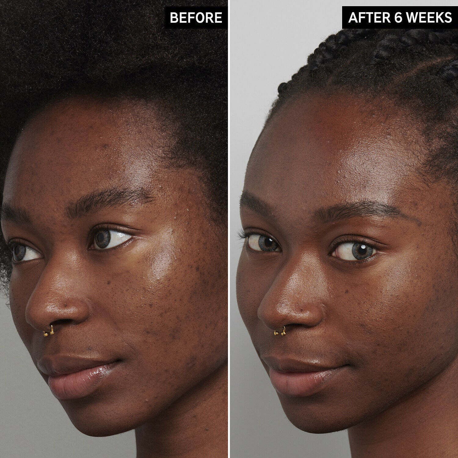 Natbehandling med tranexaminsyre mod hyperpigmentering