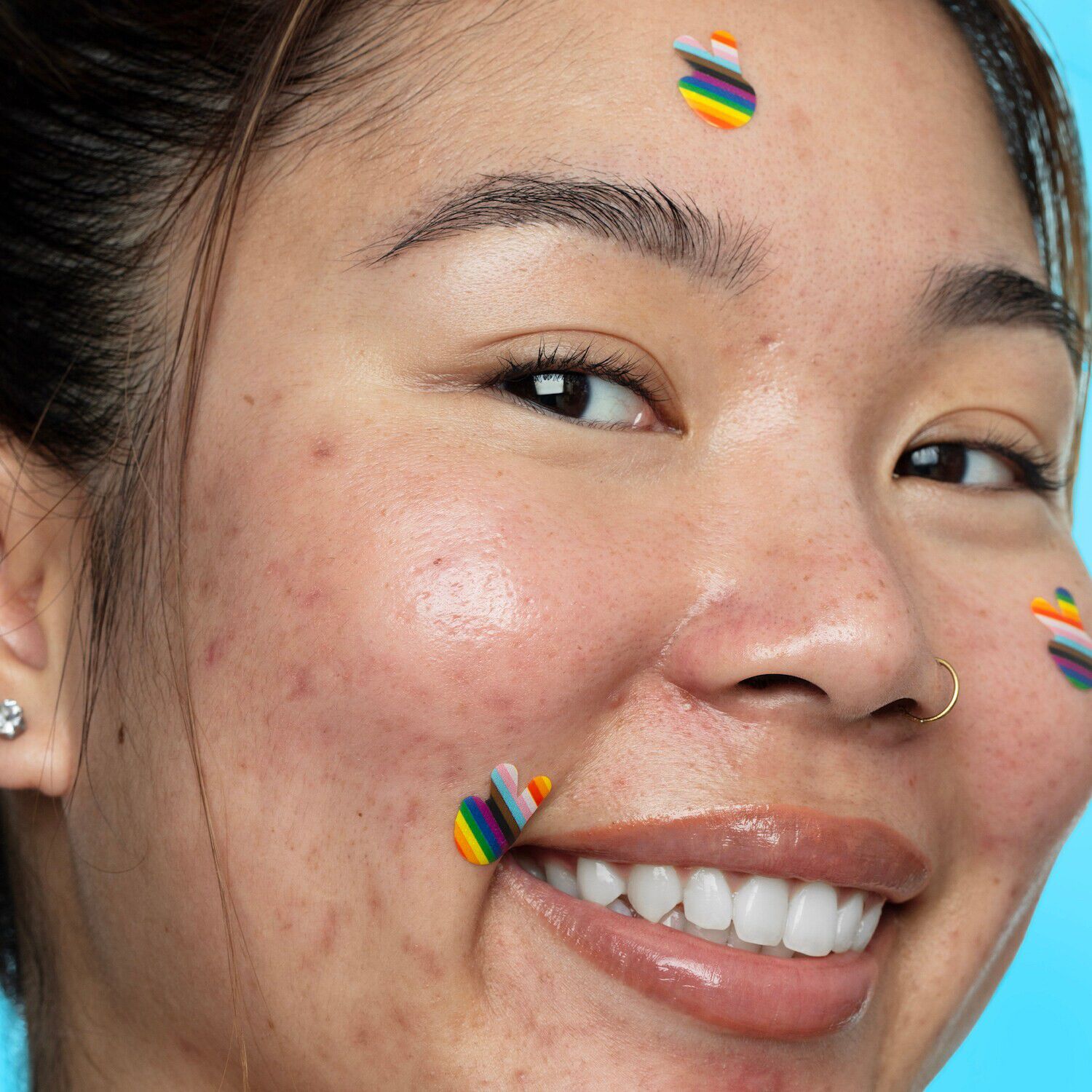 Pride Limited Edition-plastre til at pleje akne ved hj&aelig;lp af salicylsy