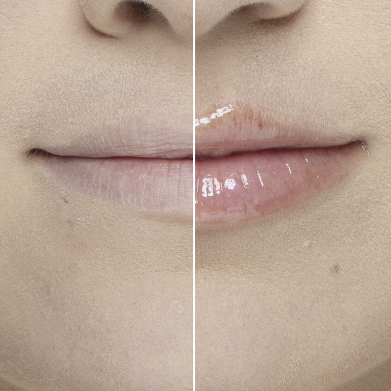 Lip Injection - Extreme Mini