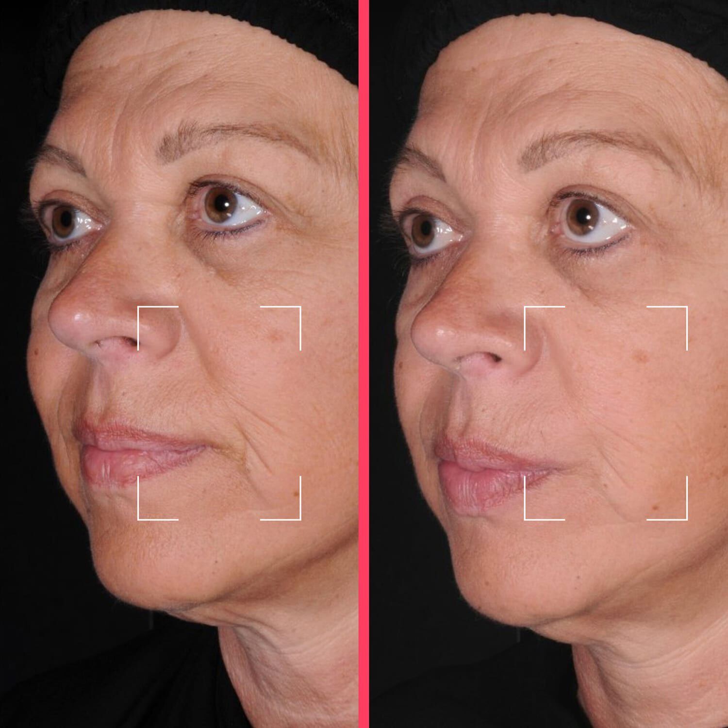 Lift kapsler - L&oslash;ftende serum beriget med niacinamid, peptid og HA