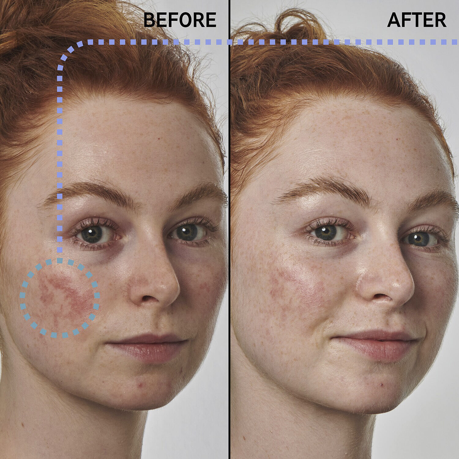 Redness Solution with 10% Azelaic - Face Serum