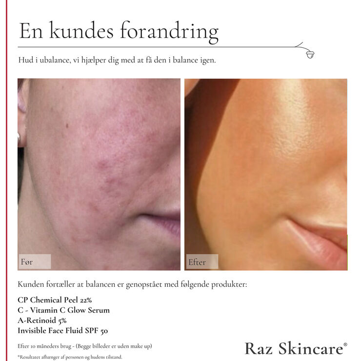 CP Chemical Peel 22% 30 ml