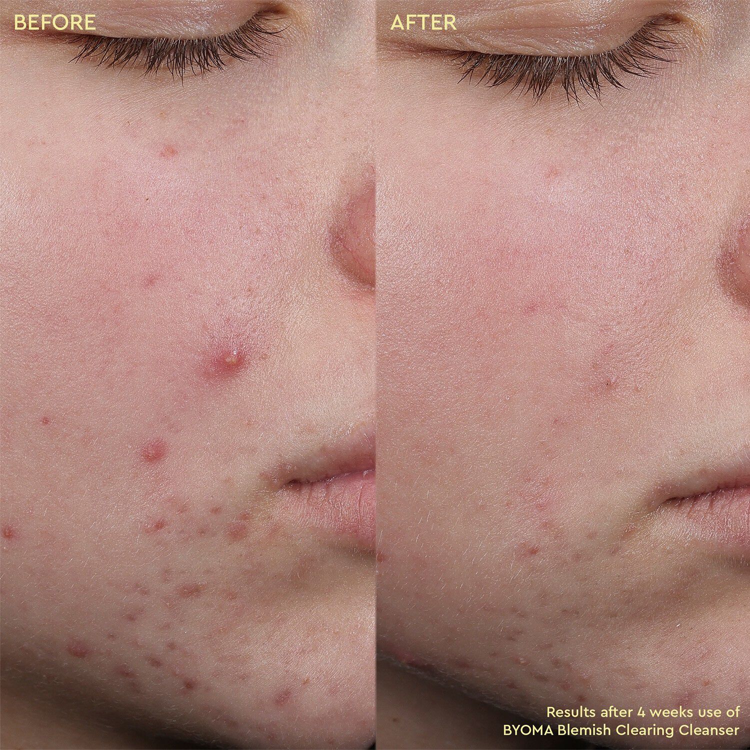 Blemish Clearing Cleanser - Anti-imperfektionsrensning