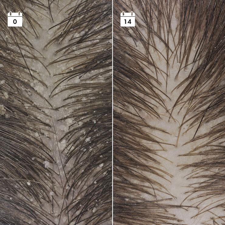 Serum mod tilbagevendende skæl - Serum til hovedbunden